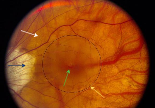 хориоретинальная дистрофия сетчатки глаза 