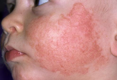 аллергия у новорожденных на лице