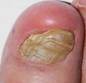 псориаз ногтей на ногах лечение