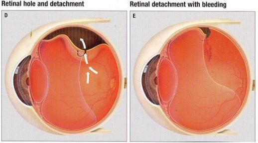 отслоение сетчатки глаза фото