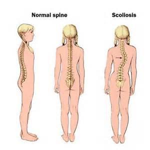 сколиоз 2 степени лечение 