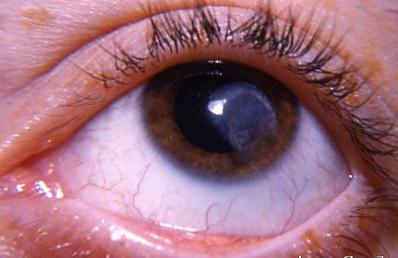 Как лечить бельмо на глазу?