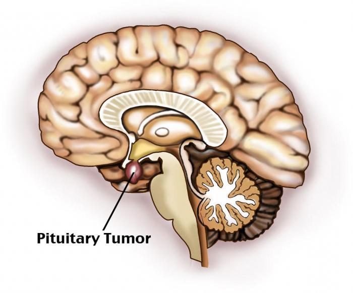 опухоль гипофиза симптомы