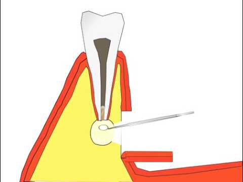 резекция верхушки корня зуба отзывы