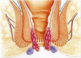 воспаление геморроидальных узлов
