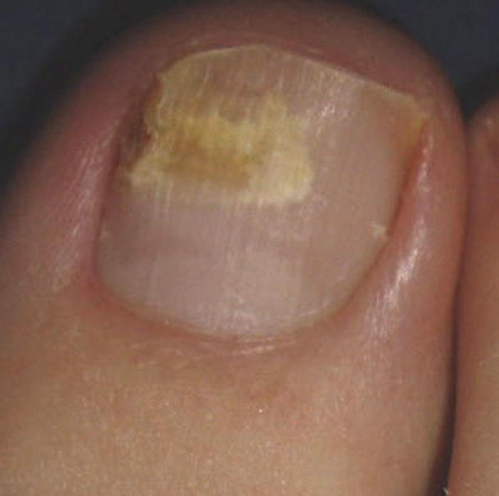 Вылечить грибок ногтей ног