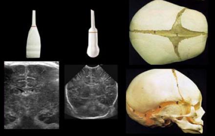 УЗИ головного мозга новорожденного