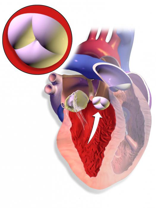 аортальный стеноз