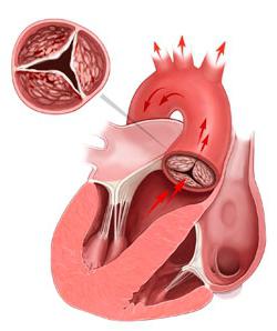 аортальный порок с преобладанием стеноза