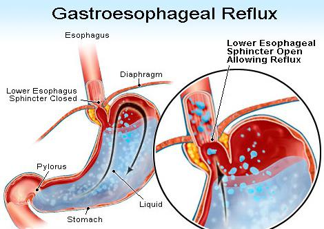 гэрб причины лечение