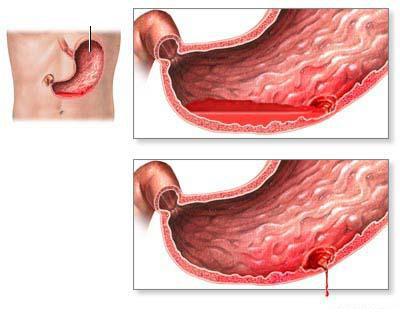 желудочное кровотечение