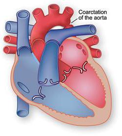 коарктация аорты