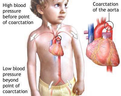 коарктация аорты у детей