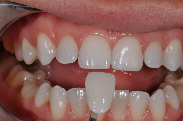  виниры в стоматологии 