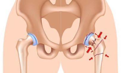 перелом бедренной кости