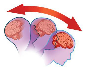 сотрясение мозга симптомы лечение