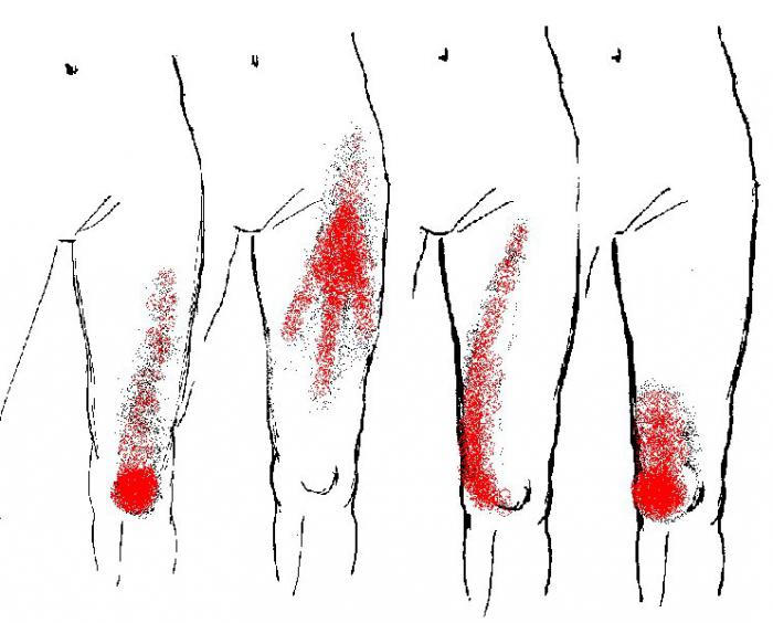 миофасциальный тазовый синдром 