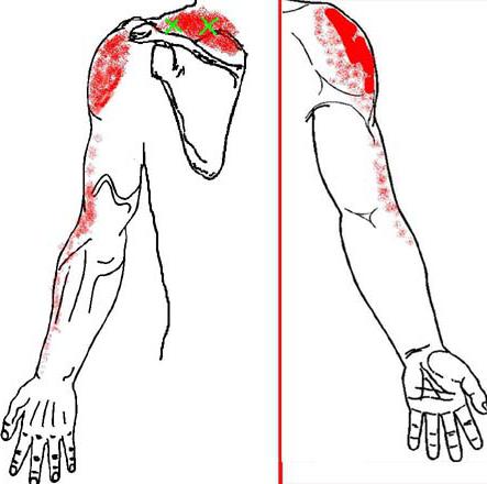 миофасциальный болевой синдром лечение 