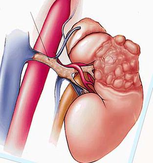 опухоль почки симптомы и лечение