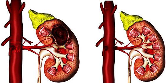 опухоль почки симптомы