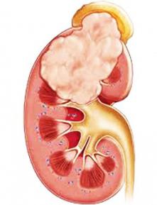 доброкачественная опухоль почки
