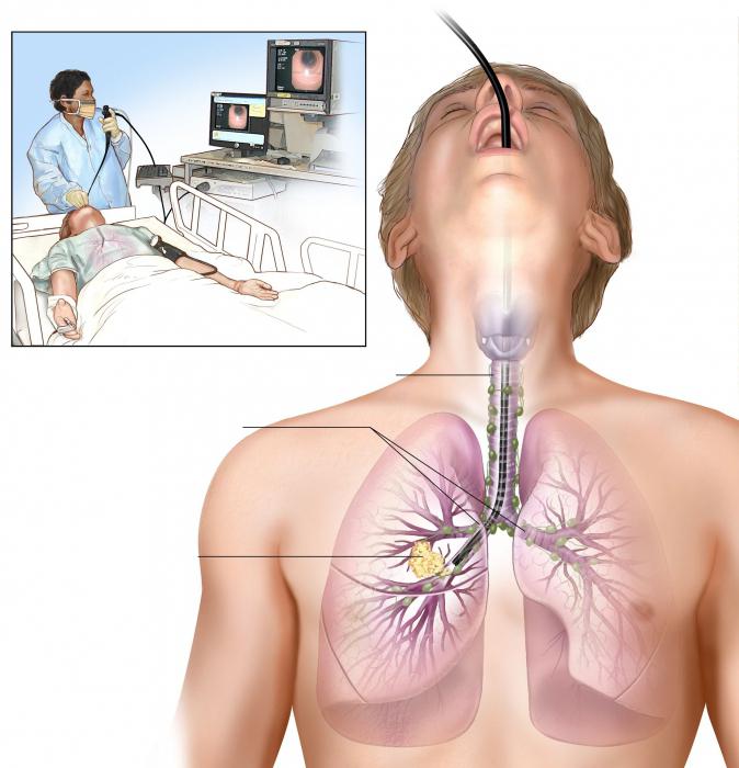 Бронхоскопия легких