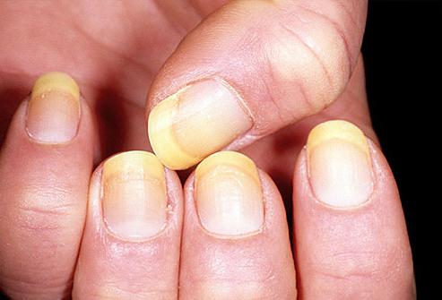 кожные заболевания на пальцах рук 