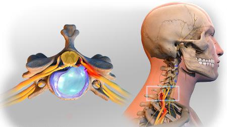 симптомы грыжи шейного отдела