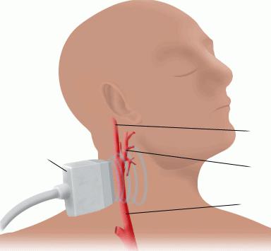 дуплексное сканирование артерий