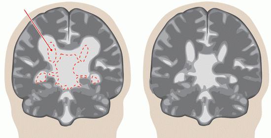 расширение желудочков головного мозга