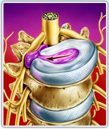 Лечение грыжи позвоночника без операции 