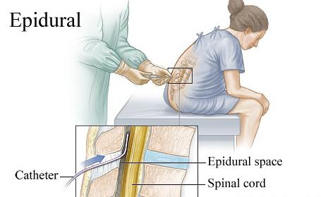 как делают эпидуральную анестезию