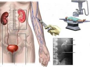 внутривенная урография