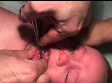 подрезание уздечки языка у новорожденных