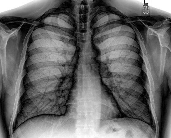 рентгенография грудной клетки заключение 