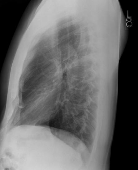 рентгенография грудной клетки норма 