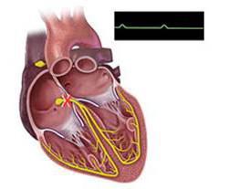 атриовентрикулярная блокада 1 степени
