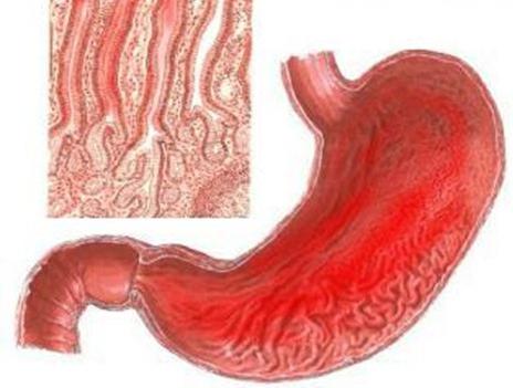 признаки гастрита желудка симптомы лечение