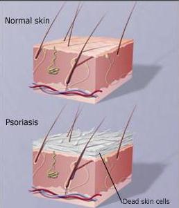 симптомы псориаза кожи