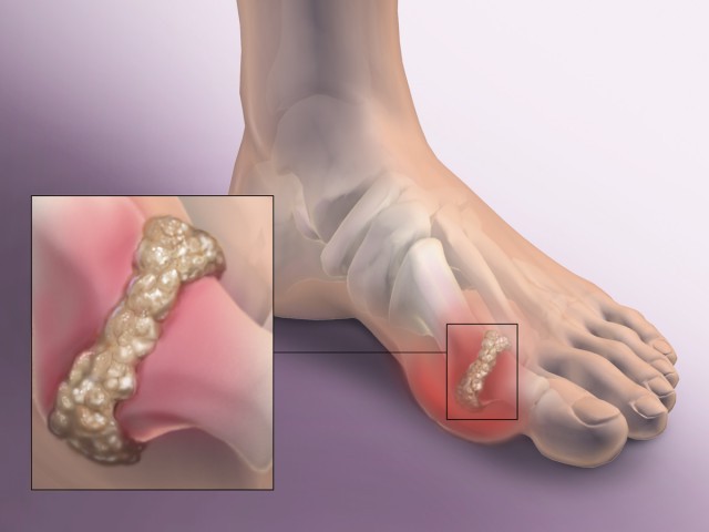 подагра большого пальца на ноге