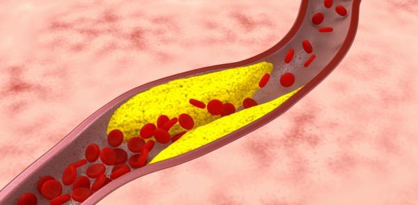 атеросклеротическая болезнь сердца