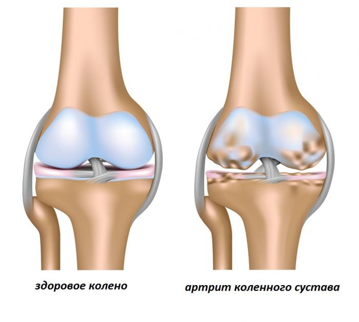 лечение артрита коленного сустава препараты