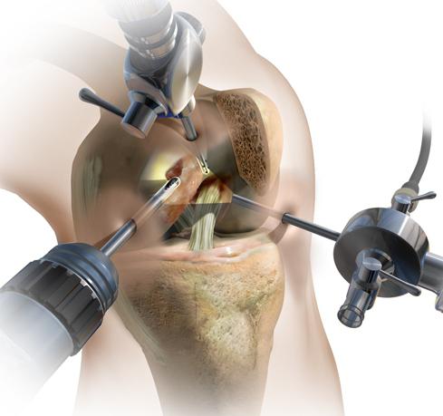 артроскопия коленного сустава операция