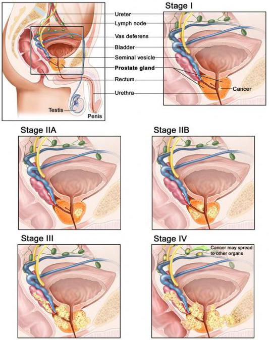 рак простаты
