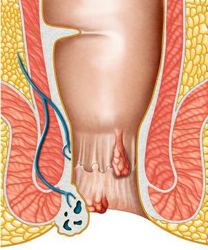 лечение геморроя у мужчин 