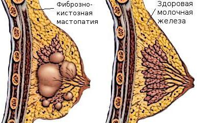 маммолептин отзывы и применение