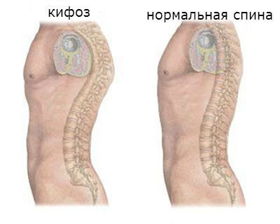 боль в грудном отделе позвоночника 