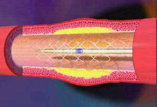 стентирование или шунтирование сосудов сердца