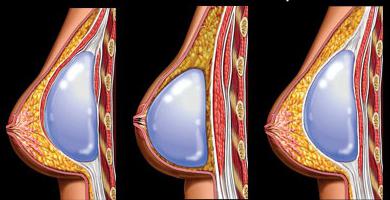 фото груди после пластики