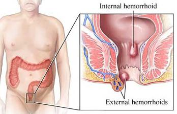лечение геморроя 3 стадии без операции